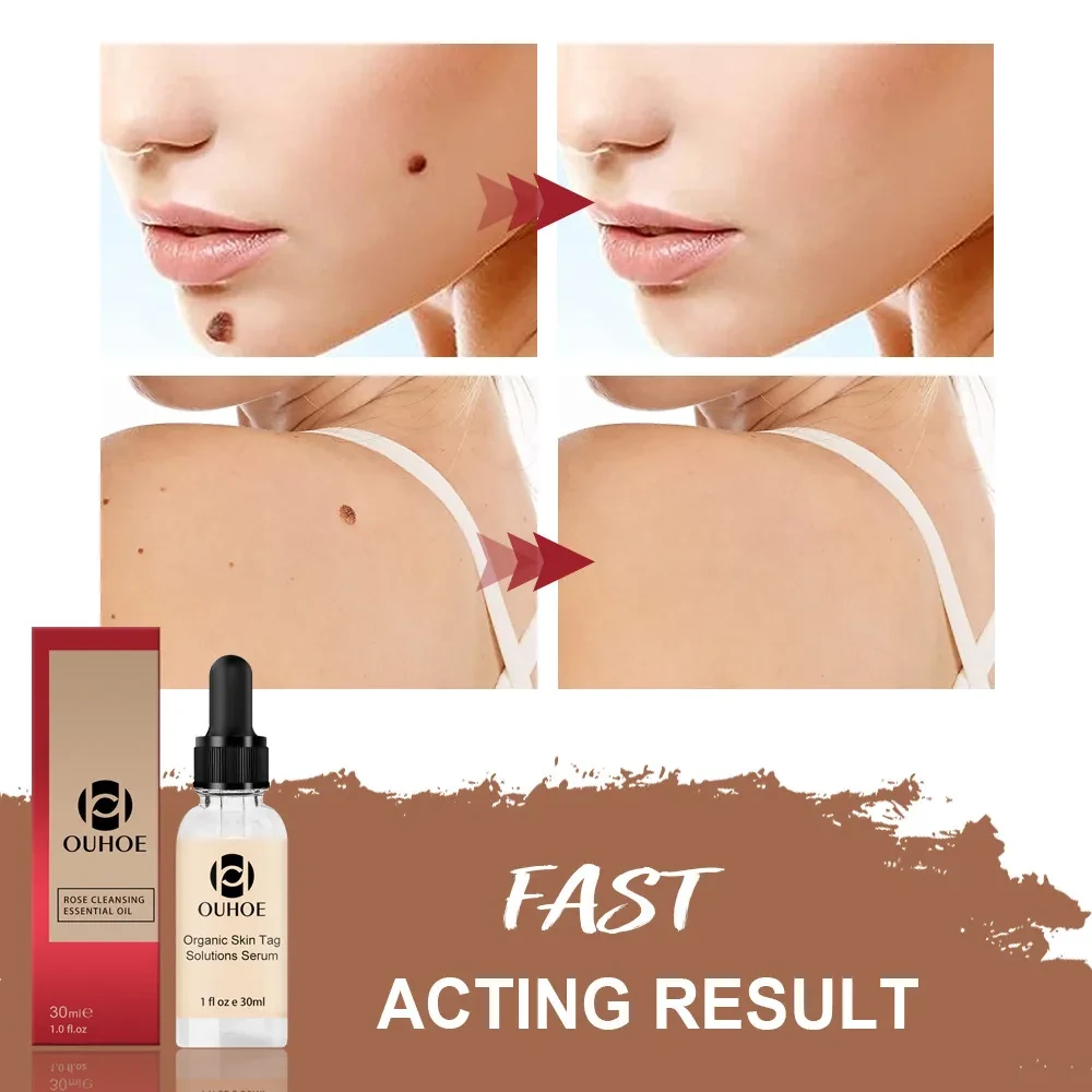 Mole Skin care lotion Repair Mole Black Spot Mole Mole Elimination Rose Essential Oil