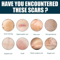 Scar Gel Skin Hyperplasia Burning Care