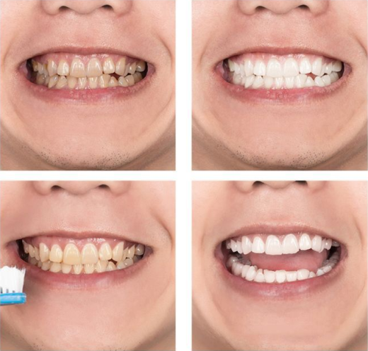 LANBENA Blue Tooth Whitening Agent