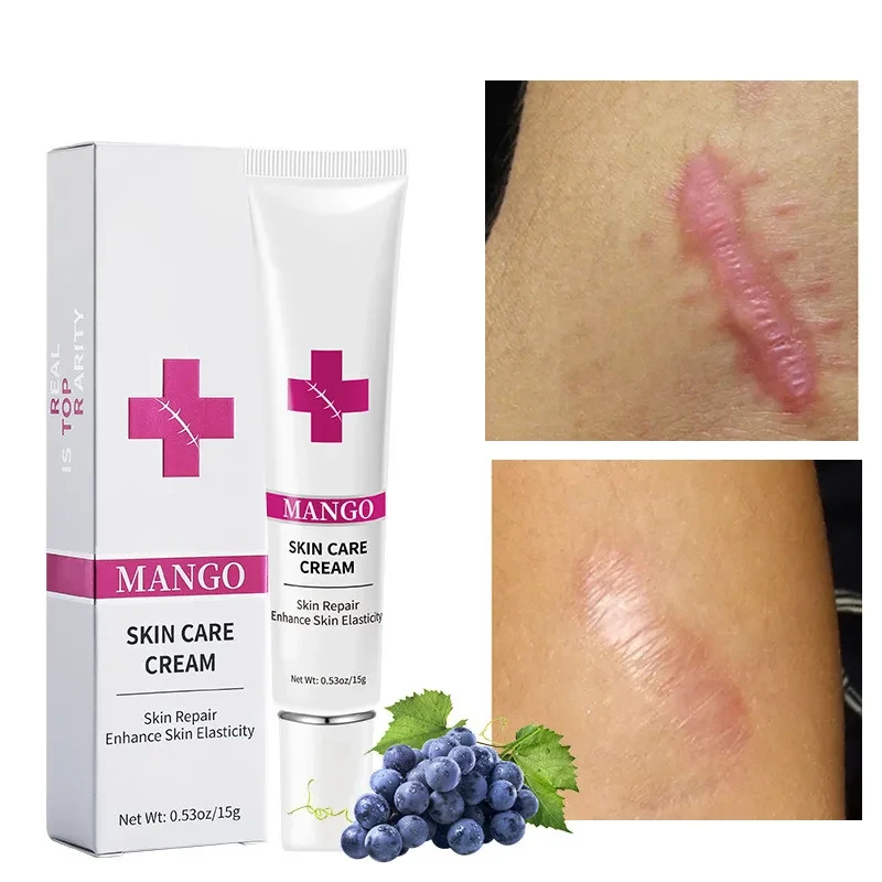 Scar Removal Cream For Men And Women