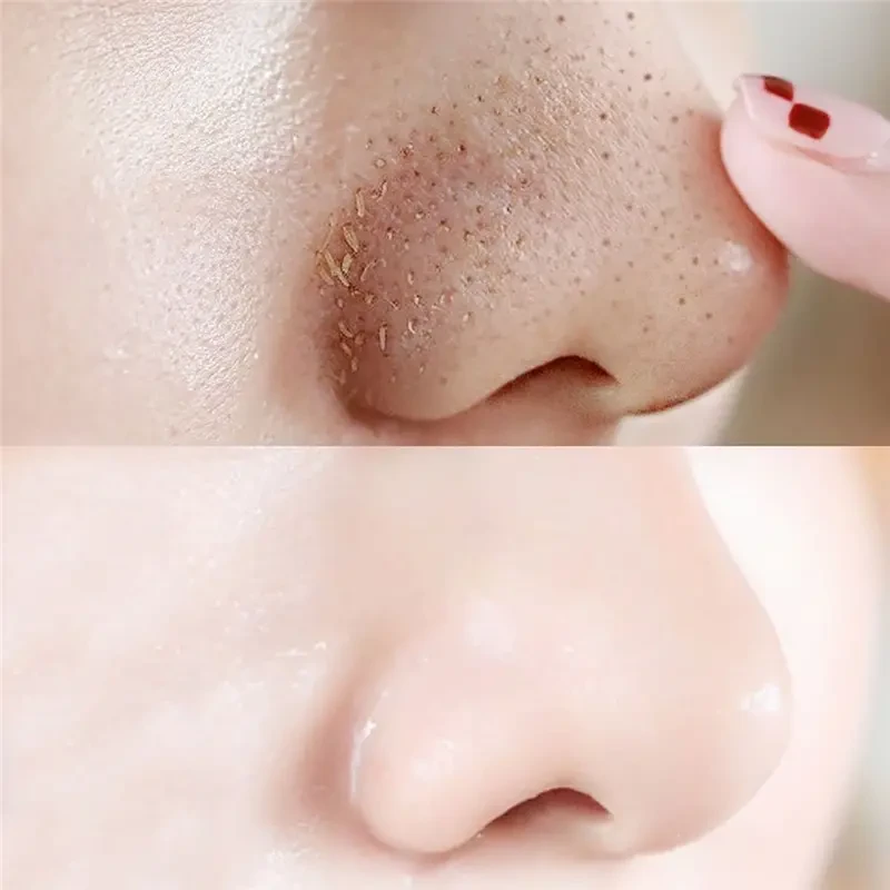 10pcs Activated Charcoal Nose Strips - Deep Cleansing & Blackhead Removal