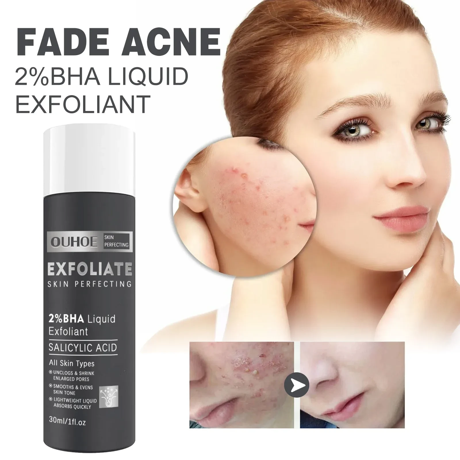 Salicylic Acne Care Solution