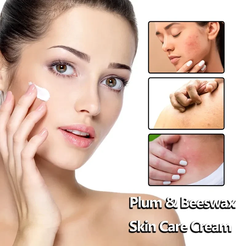 Cream Relieves Sunscreen Anti-itch Skin care lotion