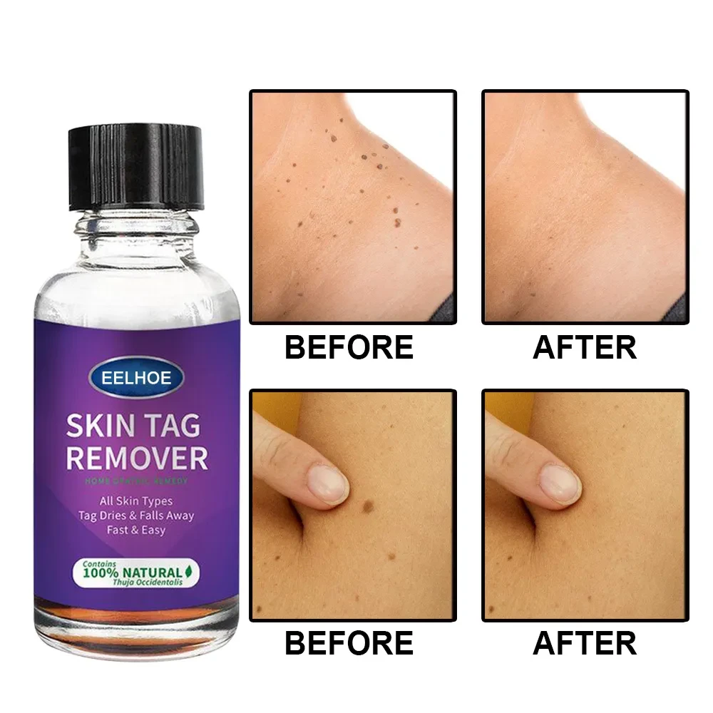 Foreign Trade Cross-Border Eelhoe Skin Verrucous Remover